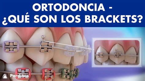 cómo funcionan los brackets